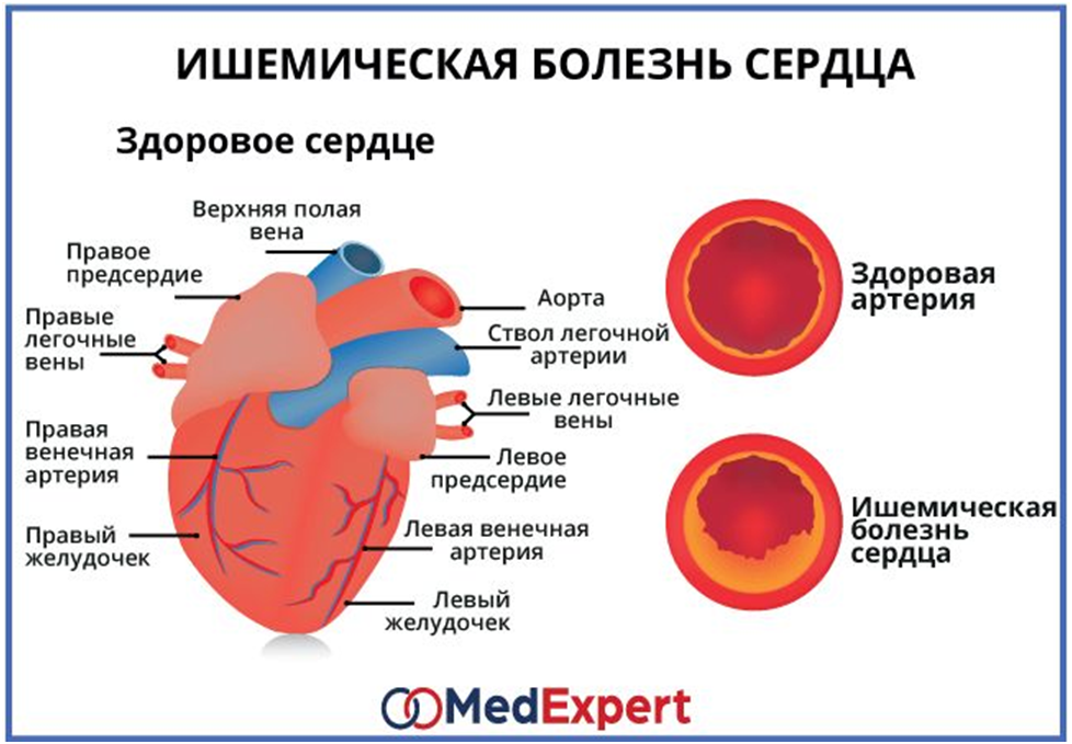 Ишемическая болезнь сердца